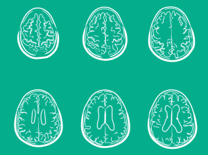 Multiple Sclerosis